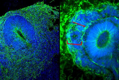  EML1-patient derived brain organoids (right picture) reveal mislocated cells (red bracket; nuclei in blue) as well as a band of mispositioned neurons (in green; red arrowheads) when compared to control brain organoids (left picture) derived from healthy donor cells.