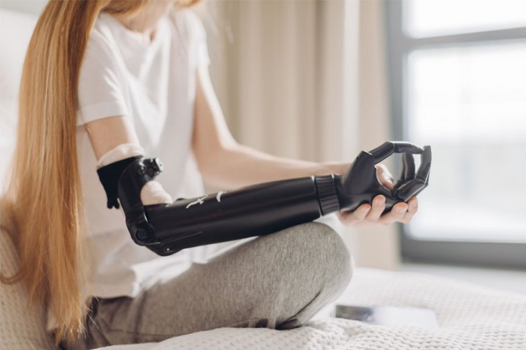 Eine Frau mit amputierten Arm und Arm-Prothese sitzt auf einem Bett.
